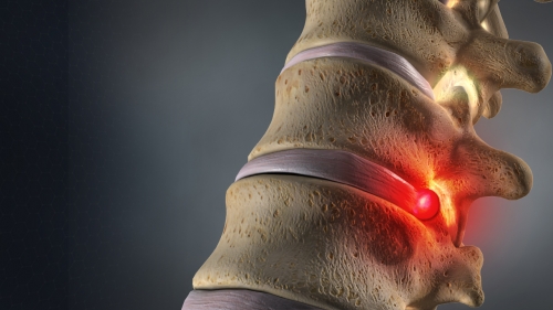 herniated disc