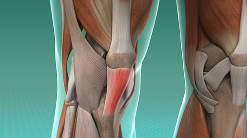 knee tendon inflammation
