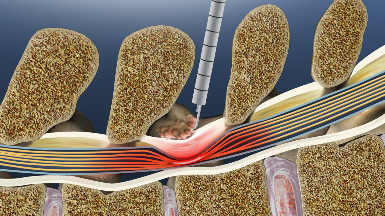 Spinal Stenosis Treatment: How the mild® Procedure Relieves Back and ...