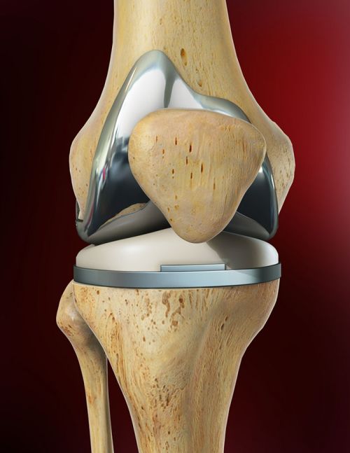 knee replacement